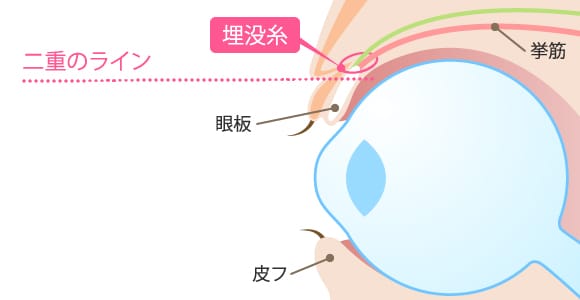 二重術スーパークイック法（埋没法）術 眼球断面図【画像】