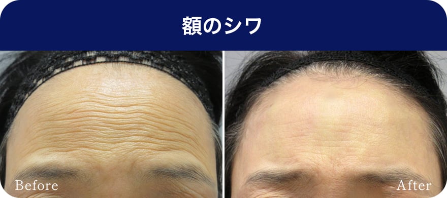 額のシワ【画像】
