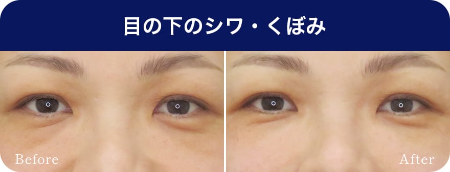 目の下のシワ・くぼみ【画像】