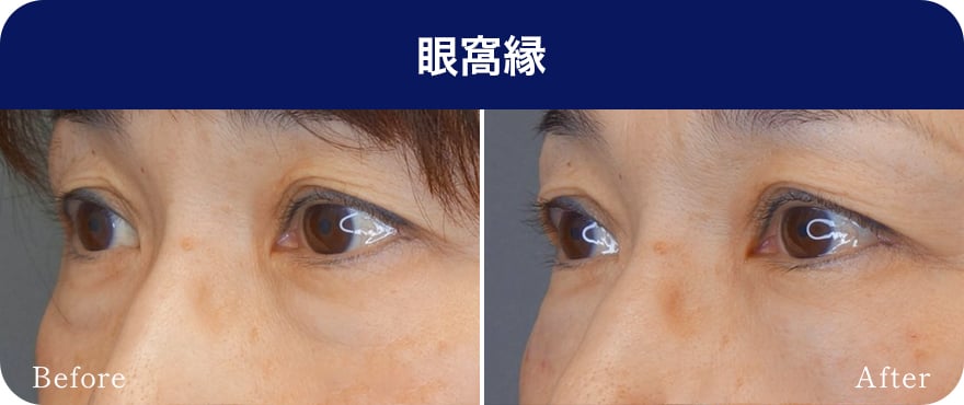 眼窩縁【画像】
