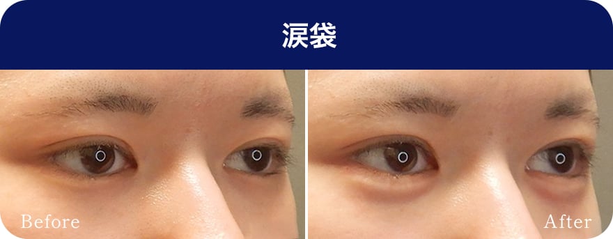 涙袋【画像】