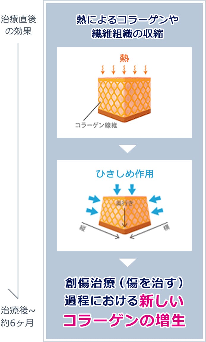 創傷治癒（傷を治す）過程における新しいコラーゲンの増生【画像】