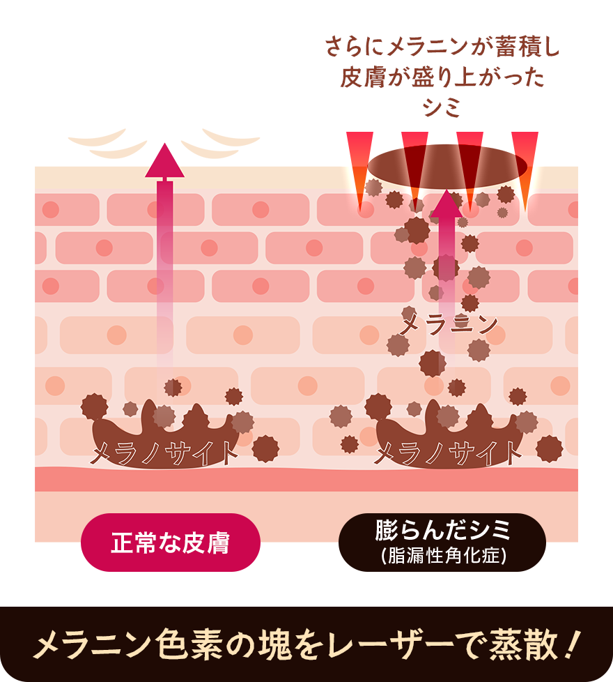 メラニンのかたまりをレーザーで蒸散！