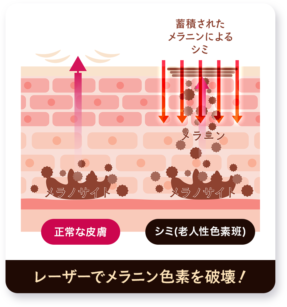 レーザーでメラニン分解！