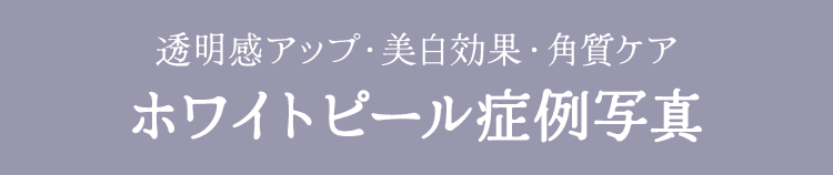 透明感アップ・美白効果・角質ケア ホワイトピール症例写真