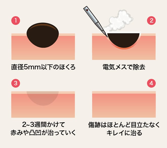 ①直径5mm以下のほくろ ②電気メスで除去 ③2～3週間かけて赤みや凸凹が治っていく	④傷跡はほとんど目立たなくキレイに治る