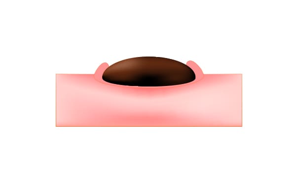 黒ニキビ【画像】
