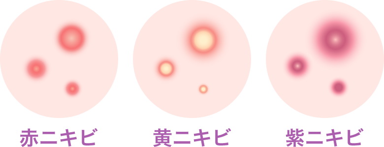 炎症ニキビ【画像】