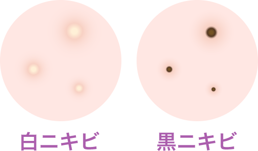 非炎症ニキビ【画像】