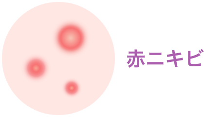 赤ニキビ【画像】