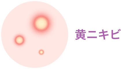 黄ニキビ【画像】