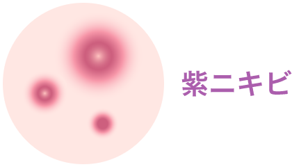 紫ニキビ【画像】