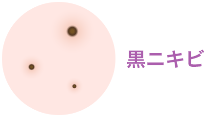 黒ニキビ【画像】
