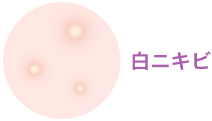 白ニキビ【画像】
