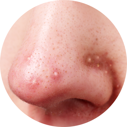 鼻にできるニキビ【画像】