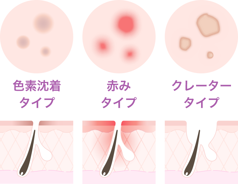 炎症ニキビ【画像】