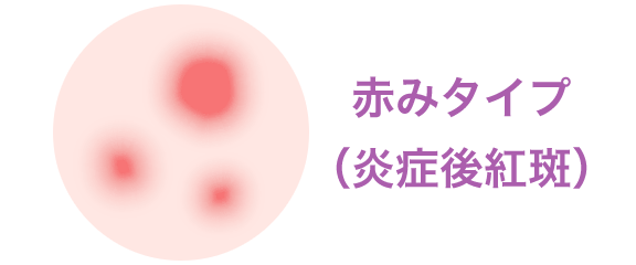 赤みタイプ（炎症後紅斑）【画像】