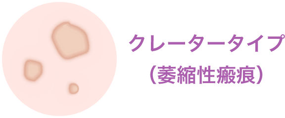 クレータータイプ（萎縮性瘢痕）【画像】