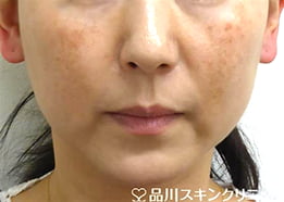 肝斑（かんぱん）とは【画像】