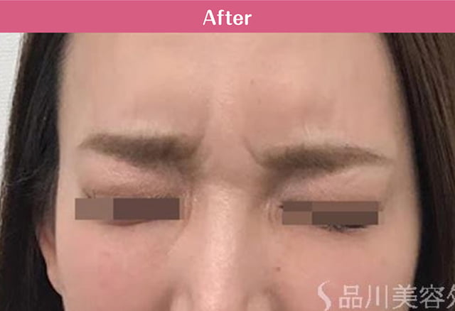 アラガン社ボツリヌス注射 症例写真 After