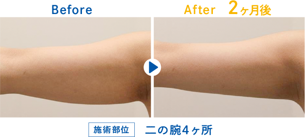Before After 2ヶ月後 二の腕4ヶ所
