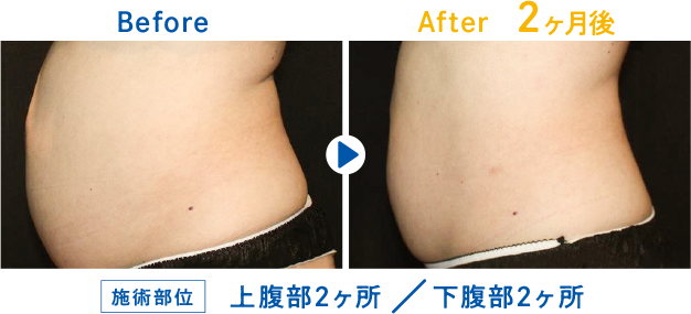 Before After 2ヶ月後 上腹部2ヶ所 / 下腹部2ヶ所