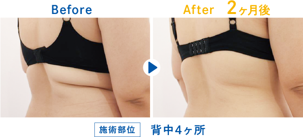 Before After 2ヶ月後 背中4ヶ所