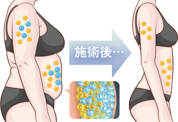 施術後に脂肪細胞が減少していくイメージ