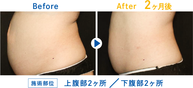 クールスカルプティング 腹部の症例