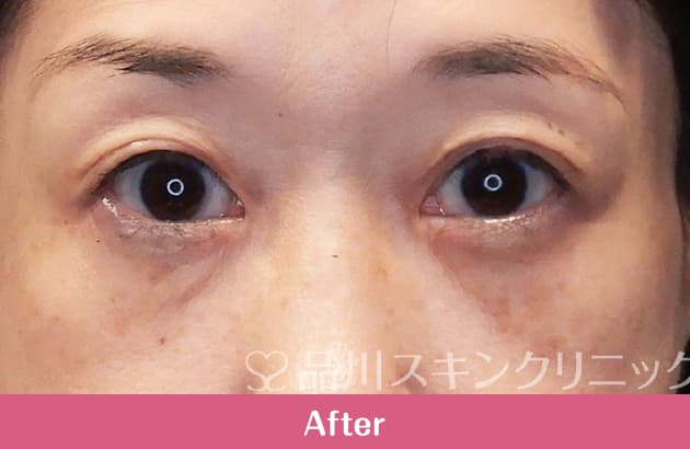 目の下のふくらみ取りプレミアム 症例写真 After