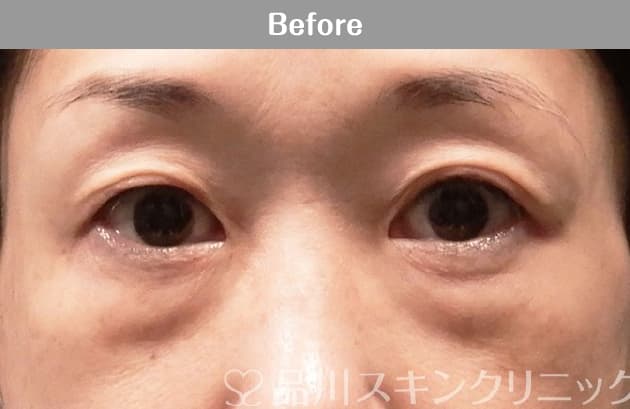 目の下のふくらみ取りプレミアム 症例写真 Before
