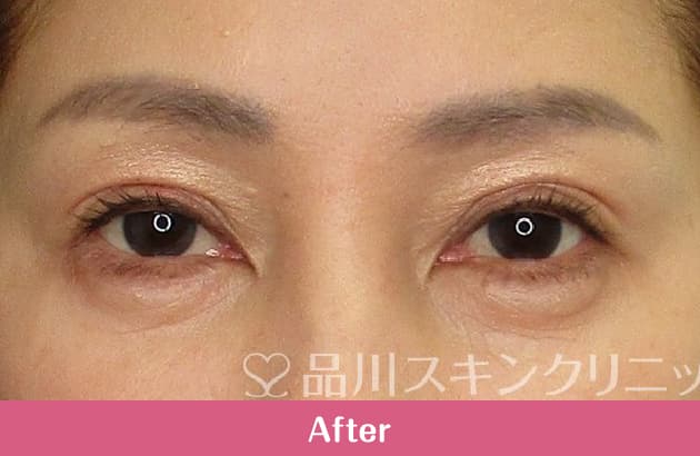 まぶたリフト（切らないまぶたのたるみ取り） 症例写真 After