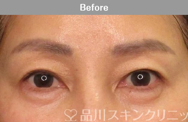 まぶたリフト（切らないまぶたのたるみ取り） 症例写真 Before