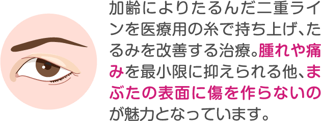 加齢によりたるんだ二重ラインを医療用の糸で持ち上げ、たるみを改善する治療。腫れや痛みを最小限に抑えられる他、まぶたの表面に傷を作らないのが魅力となっています。
